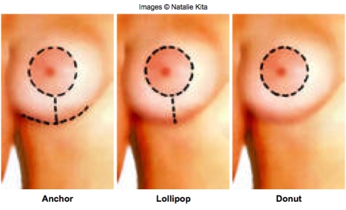 breast lift scars. reast lift scars, mastopexy