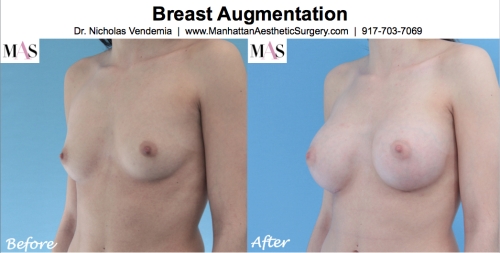 Before and After Breast Implants by NYC Plastic Surgeon Dr Nicholas Vendemia of MAS | 917-703-7069