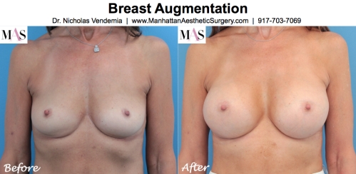 Before and After Breast Augmentation by NYC Plastic Surgeon Dr Nicholas Vendemia of MAS | 917-703-7069