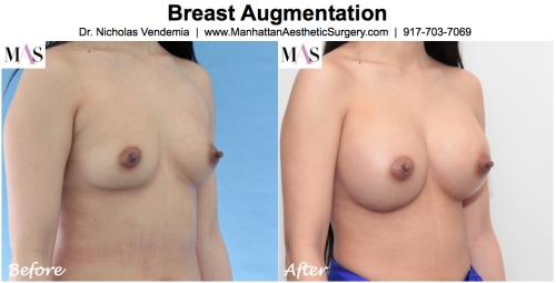 breast augmentation new york by dr nicholas vendemia plastic surgeon at MAS Manhattan Aesthetic Surgery